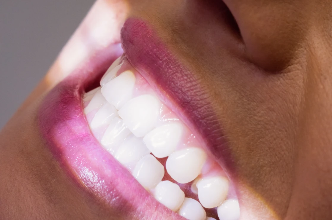 Tratamientos Dentales-Blanqueamiento