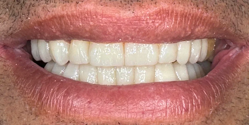 carillas dentales