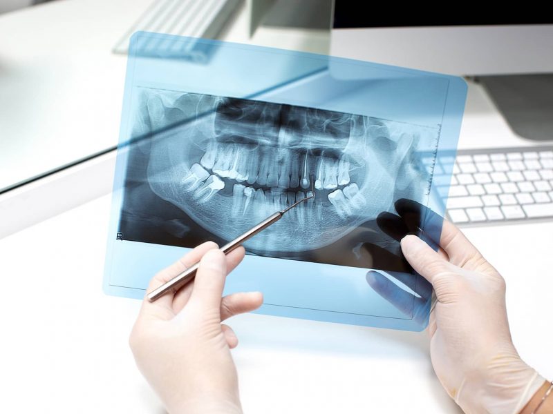Tratamiento dental endodoncia